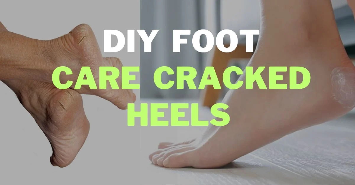 Worried about your cracked heels? Easy home remedies to treat them | Health - Hindustan Times